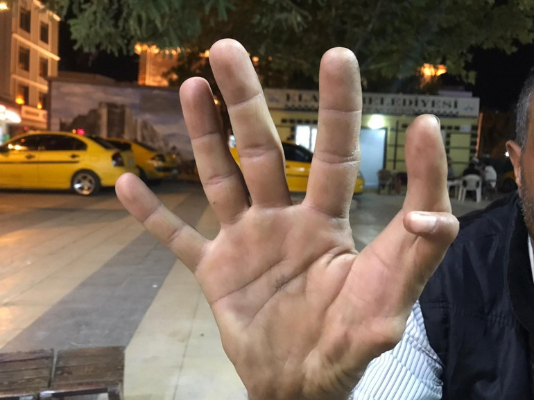Elazığda 11 parmaklı adam görenleri hayrete düşürüyor