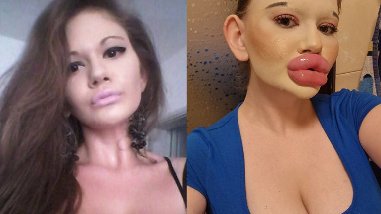 Dünyanın en büyük dudaklı kadını Doktorlar ölebileceğimi söylüyor ama durmayacağım