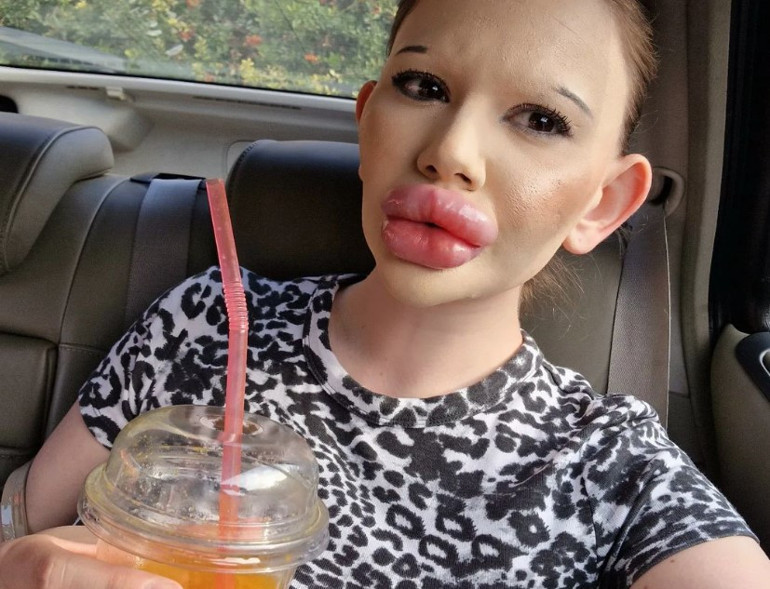 Dünyanın en büyük dudaklı kadını Doktorlar ölebileceğimi söylüyor ama durmayacağım