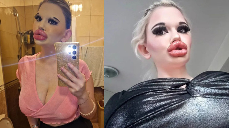 Dünyanın en büyük dudaklı kadını Doktorlar ölebileceğimi söylüyor ama durmayacağım