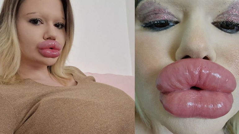 Dünyanın en büyük dudaklı kadını Doktorlar ölebileceğimi söylüyor ama durmayacağım