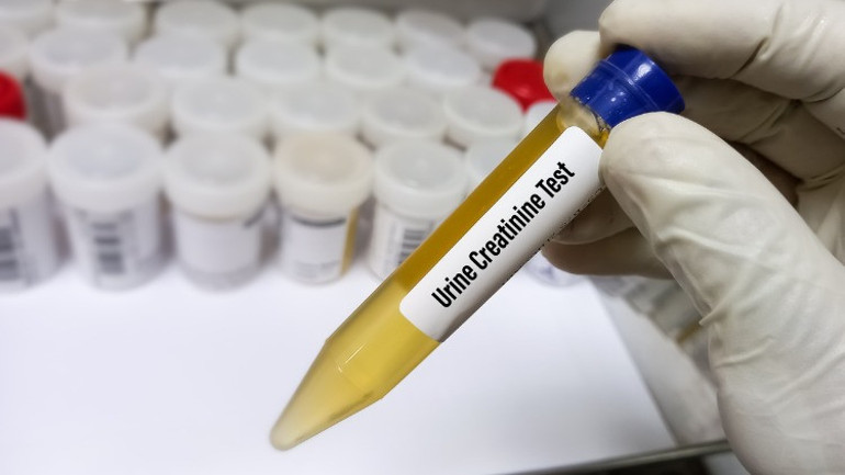 İdrar deyip geçmeyin birçok hastalığın habercisi olabilir... Hangi renk tehlikeli