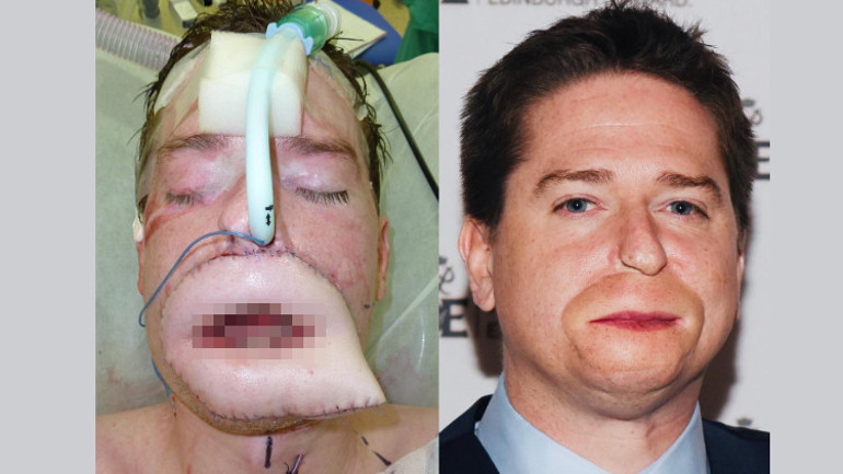 Sadece grip olduğunu sanmıştı, iki kolunu ve iki bacağını kaybetti