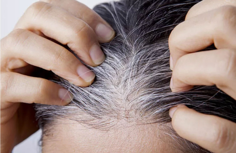 Beyazlayan saçların sorumlusu sadece yıllar mı Filmlerdeki gibi bir gecede saç beyazlar mı