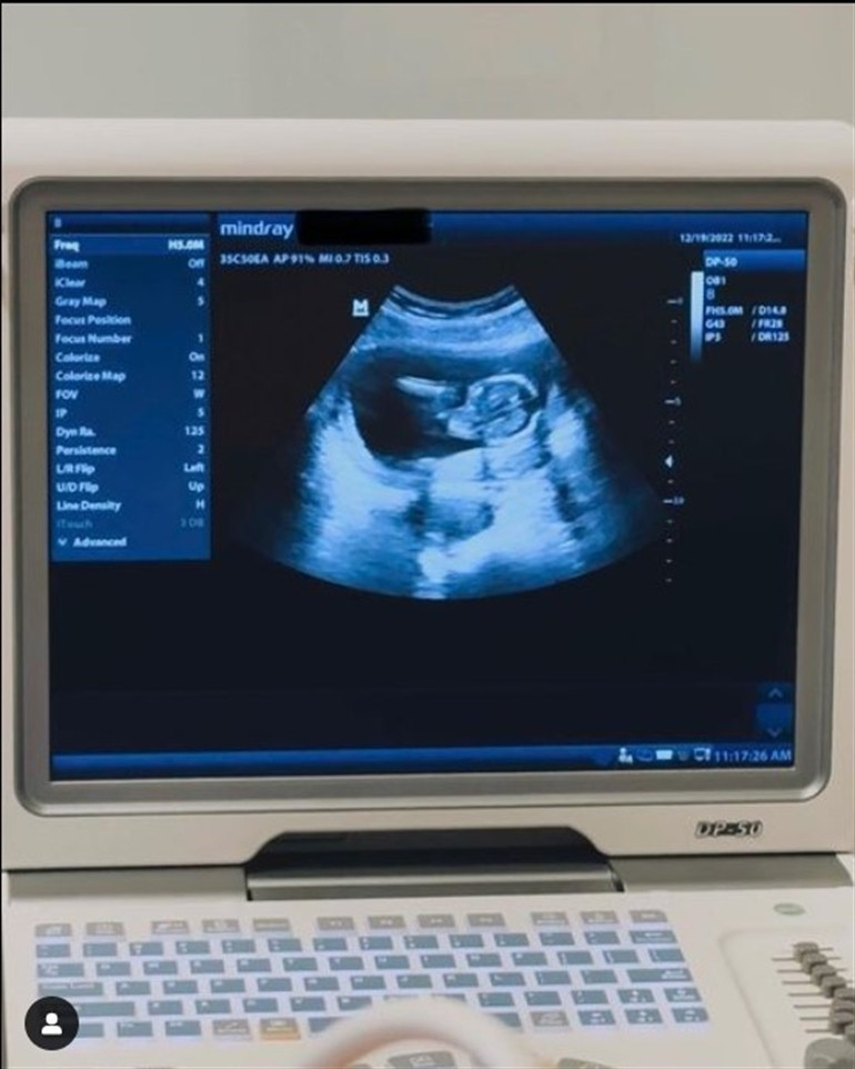 Yılı bebek müjdesiyle kapatmıştı... Instagram paylaşımı herkesi kahkahaya boğdu: Karnım büyümedi, bu bebek içimde kayboldu galiba