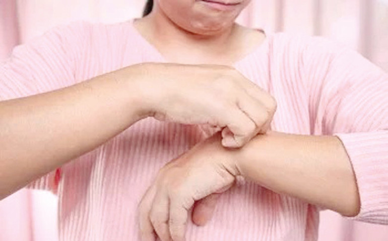 Sedef bulaşıcı değil