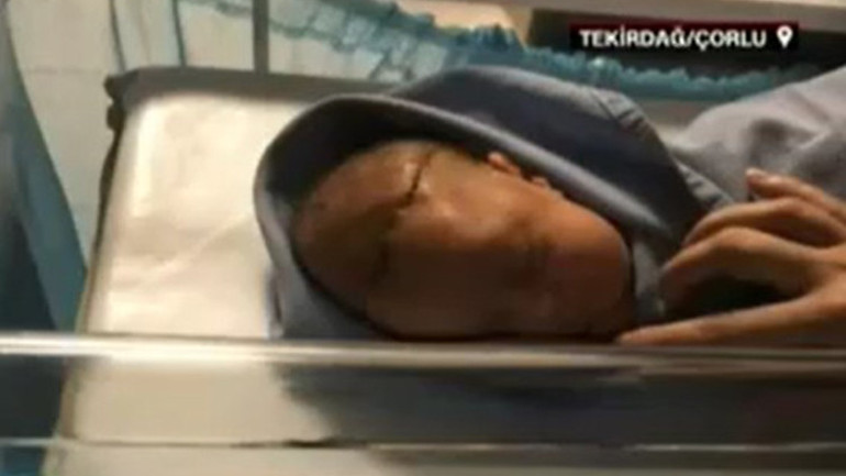 Tekirdağda akılalmaz olay... Ameliyatta bebeğin başını kesti Doğumda doktorun çığlıklarını duydum