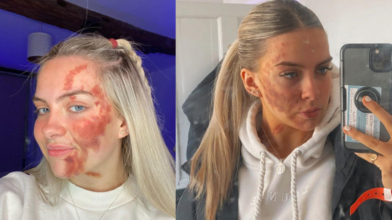 Her şey dudağındaki küçük bir sivilce ile başladı... Doktorlar teşhis koyamıyor...