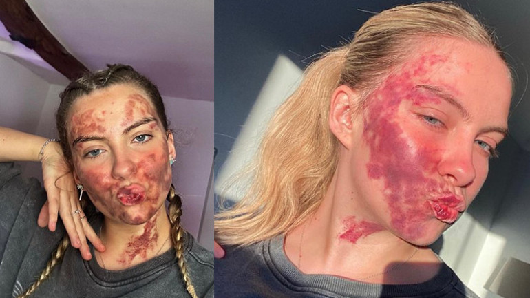 Her şey dudağındaki küçük bir sivilce ile başladı... Doktorlar teşhis koyamıyor...