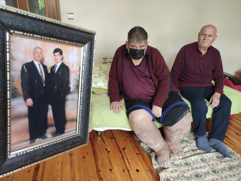 Sivrisinek ısırığı hayatını kararttı Fil hastalığı yüzünden ölümle karşı karşıya