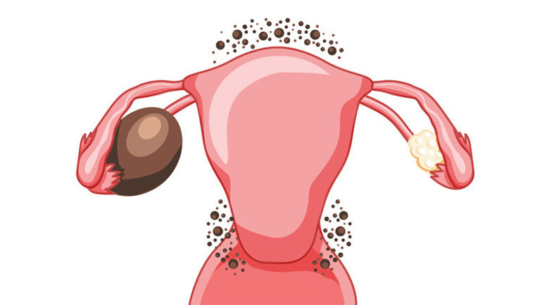 10 SORUDA ENDOMETRİOZİS DOSYASI | Dünyada ilk kez bilinen her endometriozis türünden doku üretildi