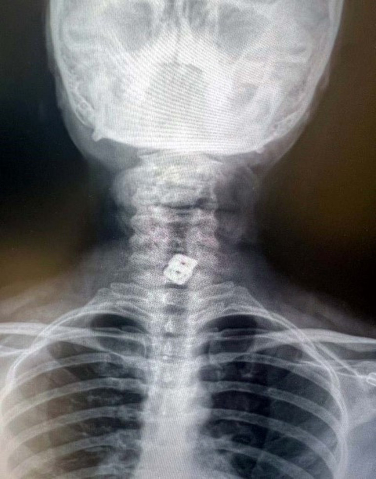 Boynuna takılan implant yemek borusunu yırtıp midesine düştü