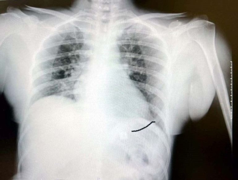 Boynuna takılan implant yemek borusunu yırtıp midesine düştü
