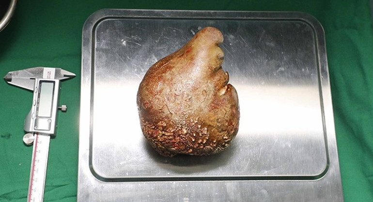 Dünya rekoru: 801 gram ağırlığında böbrek taşı çıkarıldı