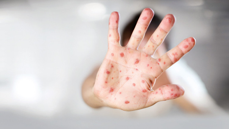 Kızamık vakaları artıyor Peki neden aşı yaptırmıyorlar