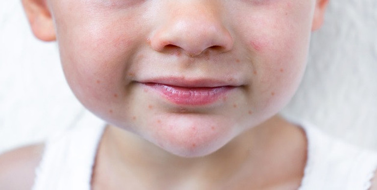 Dikkat, el ayak ağız hastalığı artıyor Özellikle çocukları hedef alıyor... ‘Sıkça karşılaşmaya başladık, çok çabuk bulaşıyor