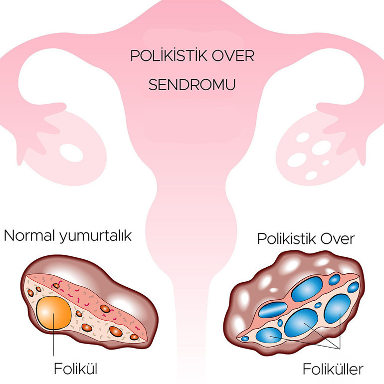 Hastalar cevapları sosyal medyada arıyor ama ne kadarı doğru Polikistik over sendromu ile ilgili 10 efsane