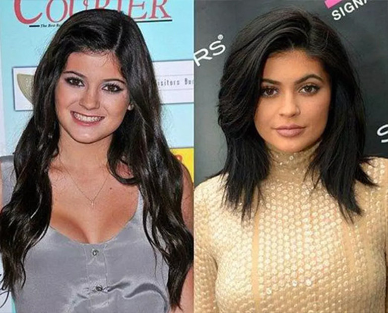 Kylie Jenner’dan beklenen itiraf geldi: Operasyon geçirdim ama pişmanım