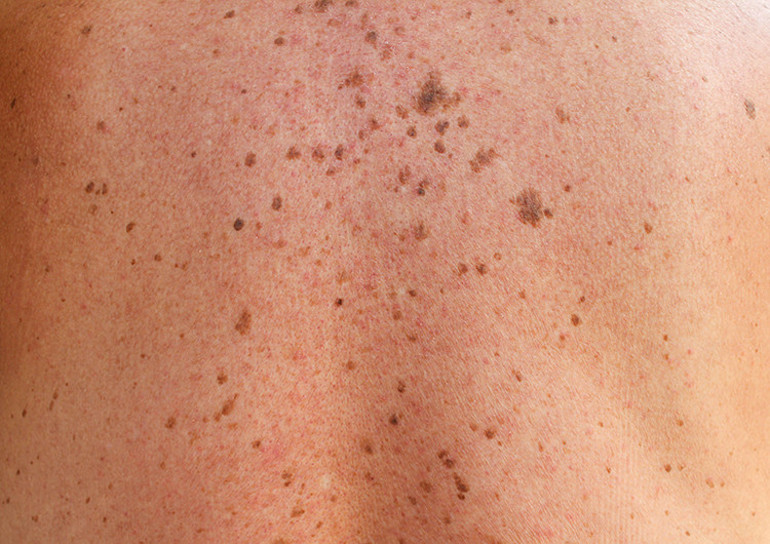 Doktorlar çilimi egzama zannetti, 4üncü evre kanser çıktı... Hangi lekeler tehlikeli Nasıl ayırt edeceğiz