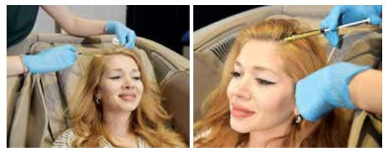 Dr. Servet Terziler yazdı: Saç tedavilerinde  kök hücre dönemi