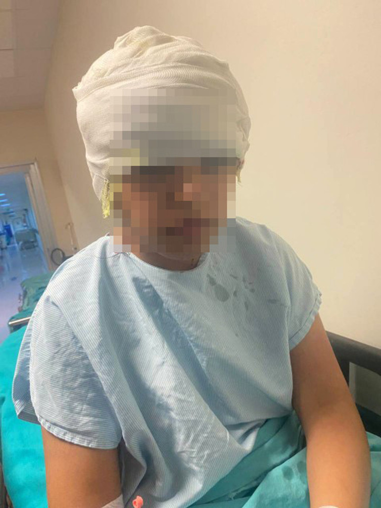 Go-kart pistinde facia Kız çocuğu ölümden döndü; saç derisi saatler süren ameliyatla dikildi