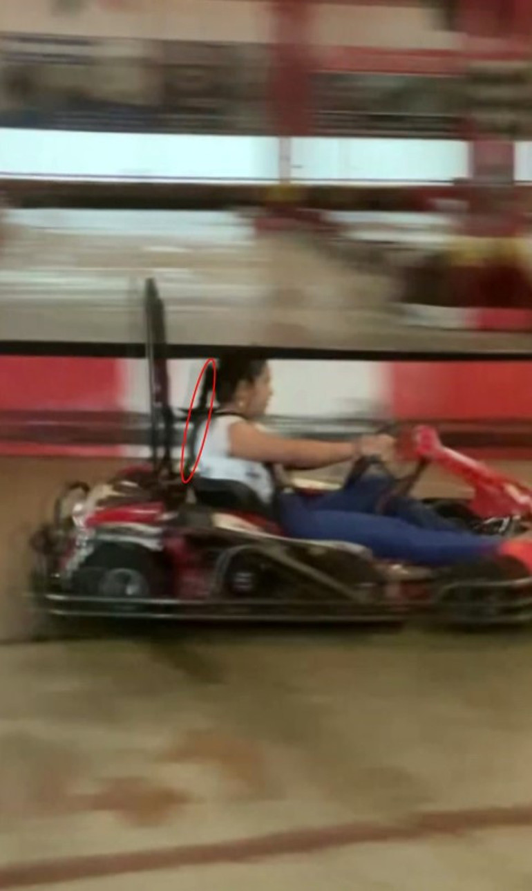 Go-kart pistinde facia Kız çocuğu ölümden döndü; saç derisi saatler süren ameliyatla dikildi