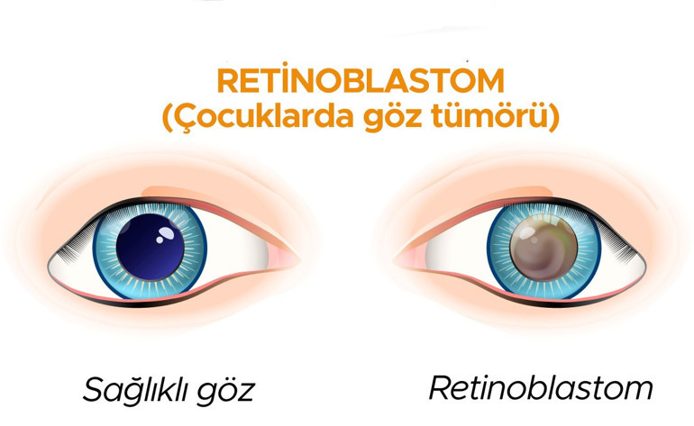 Monitörden bebeğini izlerken bir tuhaflık fark etti... Annenin dikkati sayesinde 6 aylık bebeğe nadir görülen bir retina kanseri teşhisi kondu