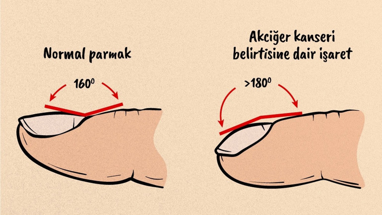 Ünlü gitarist akciğer kanserine yenik düştü Dünyada ve Türkiye’de hızla yayılıyor... Tırnak şekilleri hastalığa dair işaret veriyor
