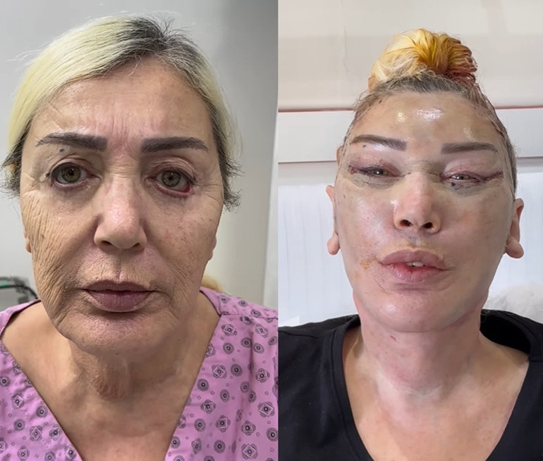 Umut Akyürek bıçak altına yattı: Alın daraltma ameliyatı geçirdim