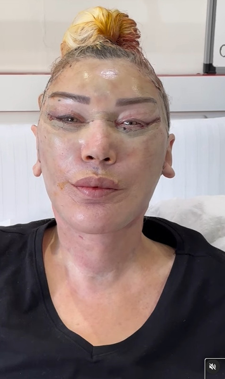 Umut Akyürek bıçak altına yattı: Alın daraltma ameliyatı geçirdim