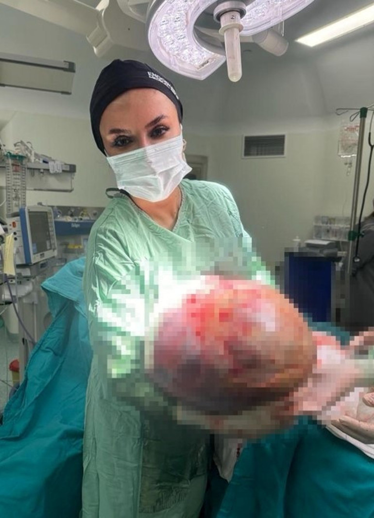 Karın şişliği için hastaneye gitti, gerçeği öğrenince şok oldu 50 santim çapında, 20 kilo ağırlığında: 1 saatlik ameliyatla alındı