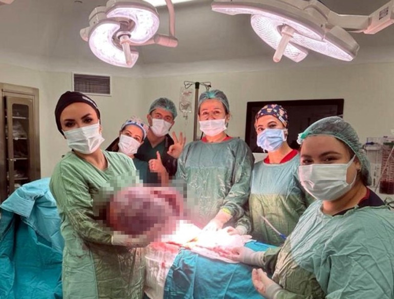 Karın şişliği için hastaneye gitti, gerçeği öğrenince şok oldu 50 santim çapında, 20 kilo ağırlığında: 1 saatlik ameliyatla alındı