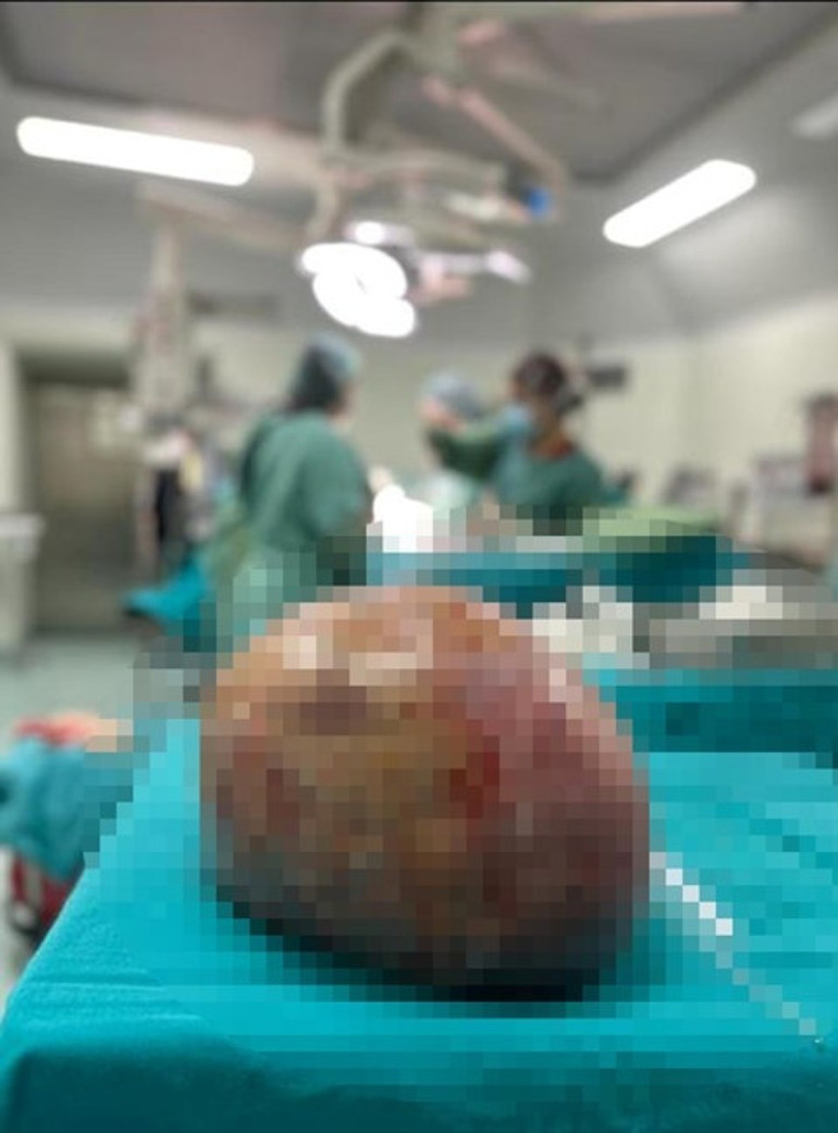 Karın şişliği için hastaneye gitti, gerçeği öğrenince şok oldu 50 santim çapında, 20 kilo ağırlığında: 1 saatlik ameliyatla alındı