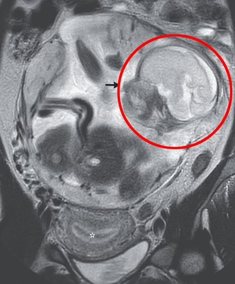Mide ağrısı ile gitti  5,5 aylık hamile olduğu ortaya çıktı Anne de doktorlar da şoke oldu: Bebek bağırsaklarında büyümüş...