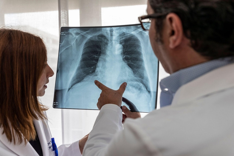 Çin ve ABD’den sonra Avrupada da görüldü: Beyaz akciğer sendromu… İnsandan insana bulaşıyor, antibiyotik tedavisi sonuç vermiyor