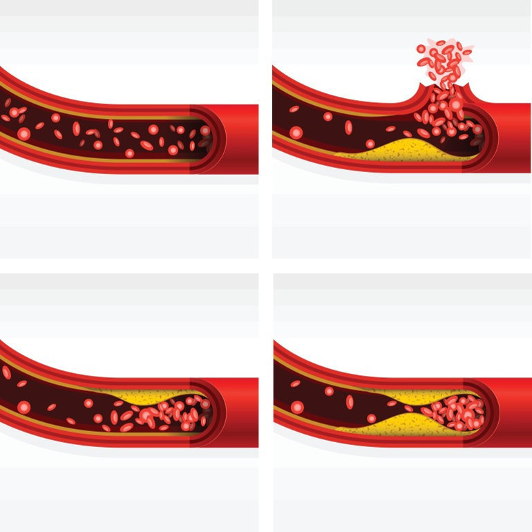 “Evladım göğsünü üşütme, önünü kapat” diyen büyüklerimiz haklı çıktı... Soğuk havalar kalbin iş yükünü artırıyor Kış aylarında şah damarı daralması ve tıkanıklığına dikkat