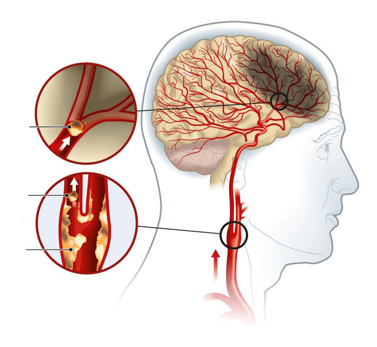 “Evladım göğsünü üşütme, önünü kapat” diyen büyüklerimiz haklı çıktı... Soğuk havalar kalbin iş yükünü artırıyor Kış aylarında şah damarı daralması ve tıkanıklığına dikkat