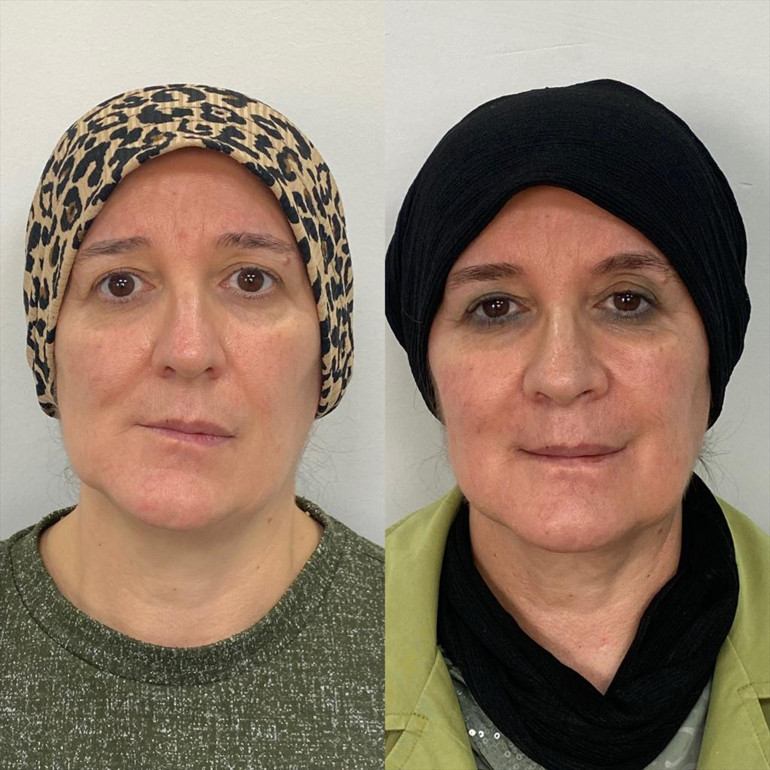 Çene ağrısı çekip, yüz asimetrileri bozulmuştu... Sebebini öğrenince hayatlarının şokunu yaşadılar: İnsan içine çıkamıyordum