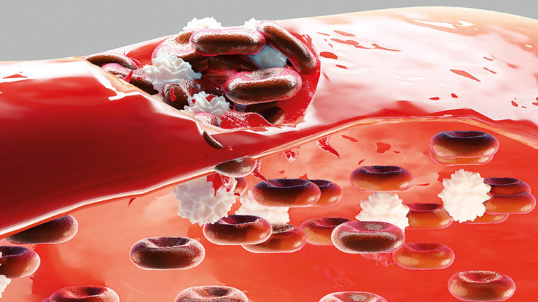 Teşhis edilmesi 7 yıl sürüyor