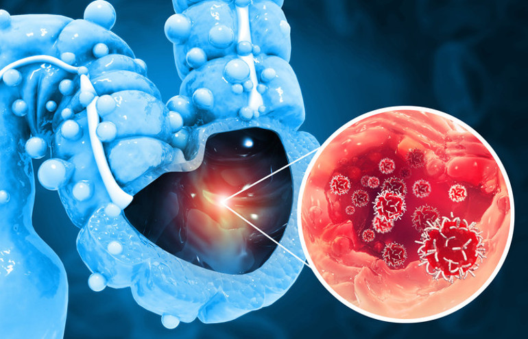 Korktuğu için yıllarca kanser belirtilerini görmezden geldi, doktorları artık çok geç olduğunu söylüyor… 31 yaşındayım ve aylar sonra ölebilirim’