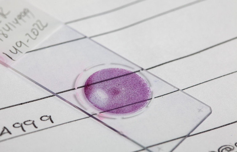 2 kez yaptırdığı smear testi negatif çıktı ama tam 14 yıl sonra 3üncü evre kanser teşhisi kondu