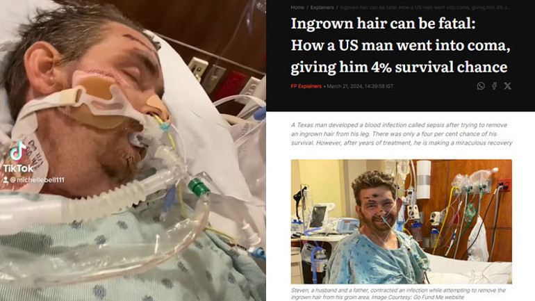 Bacağındaki kılları almaya çalışırken canından oluyordu Günlerce komada kaldı, doktorlar yaşaması için yüzde 4 şans verdi