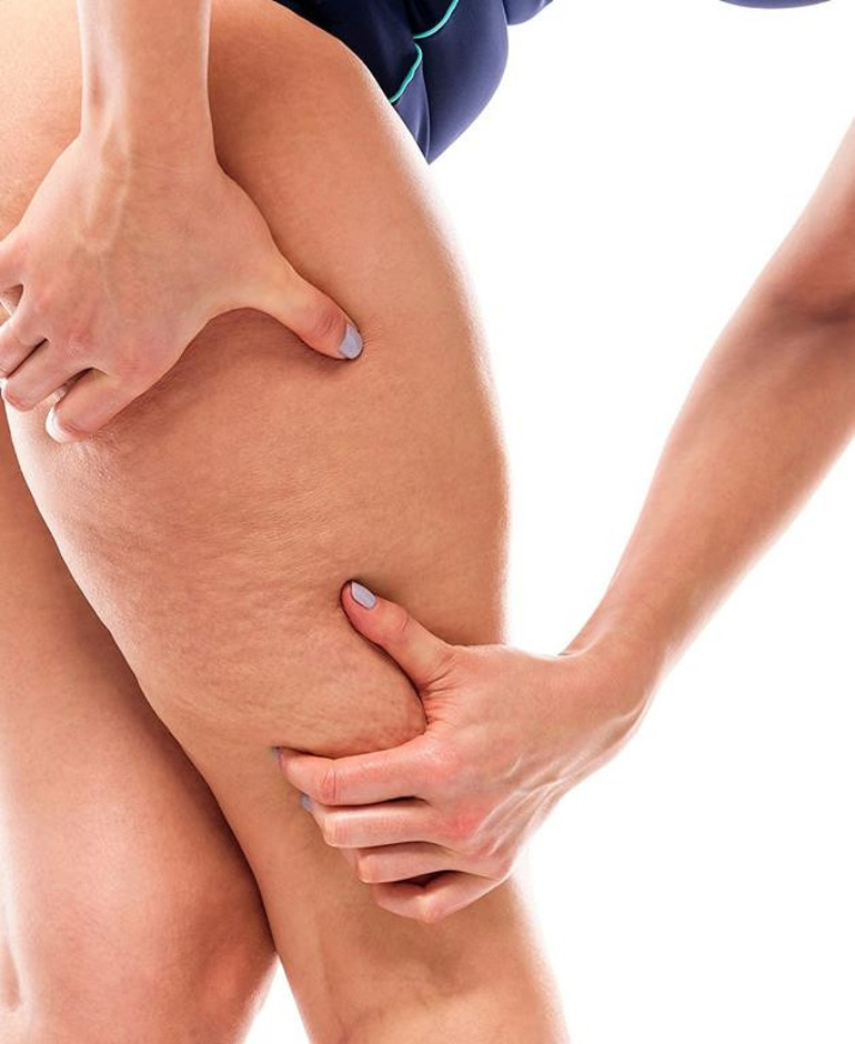 Selülitten kurtulmak mümkün mü