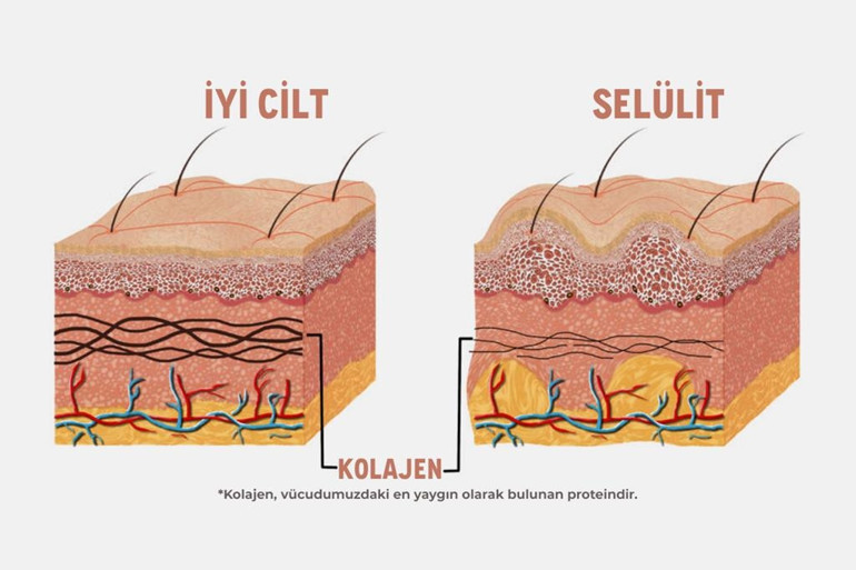 Selülitten kurtulmak mümkün mü