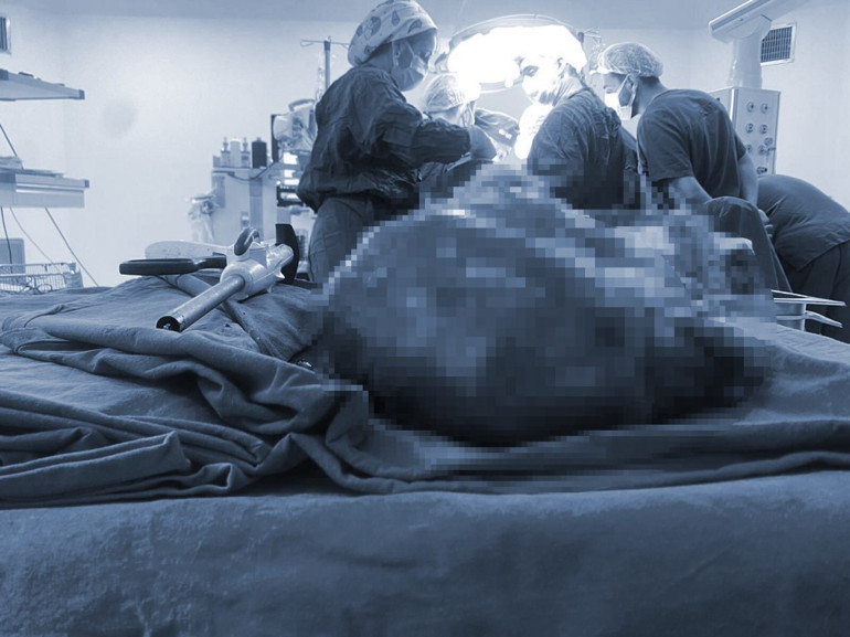 Böbrek ağrısıyla gitti, hayatının şokunu yaşadı 8 kiloluk tümörden kurtuldu: Gebe gibiydim, ikinci kez dünyaya gelmiş gibiyim