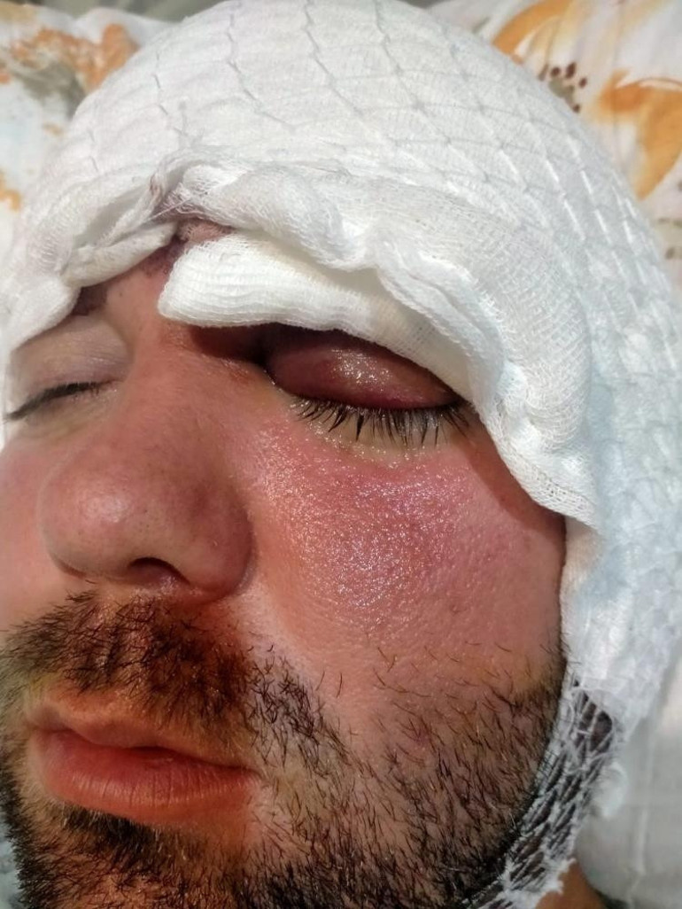 İmplant tedavisinde kan donduran olay İşlemi eliyle yapınca vida hastanın beynine saplandı... Beni hastaneye bırakıp kaçtı