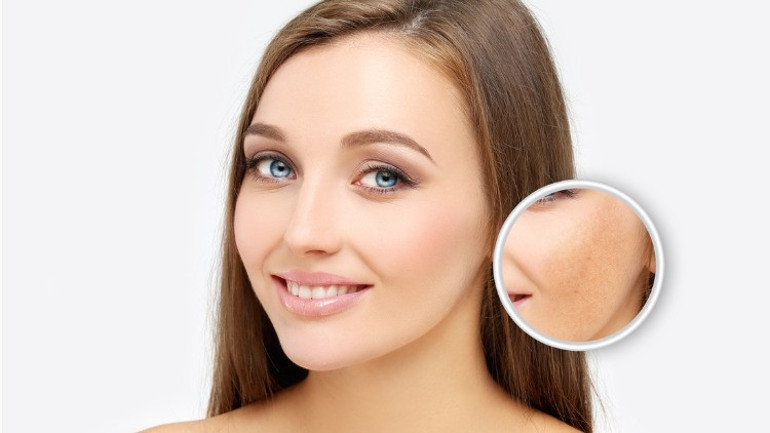 Koyu lekeler, hiperpigmentasyon ve melazma için en iyi cilt bakım önerileri