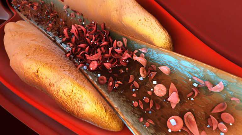 Pıhtı atmaya bağlı ölümler neden bu kadar sık yaşanmaya başladı