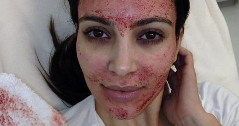 Kim Kardashian ile meşhur olmuştu... PRP işlemi sonrası üç kadına HIV bulaştı Bu nasıl mümkün olabilir 5 SORU 5 YANIT