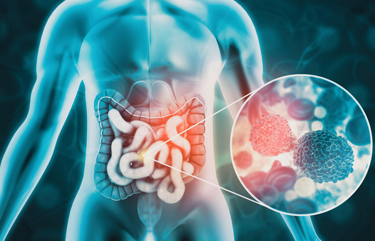 Her gün 100, yılda 35 bin gence teşhis konuyor… Kolon kanserinin 50 yaş altında daha yaygın hale gelmesinin beş nedeni